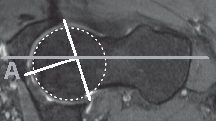 Acetabular version